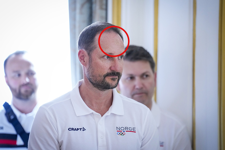 kronprins haakon mystiskt skadad – bilderna avslöjar 2 Kronprins Haakon mystiskt skadad – bilderna avslöjar